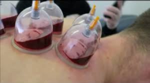 Blood Letting Hijama Wet Cupping Purifcation Back Shoulder